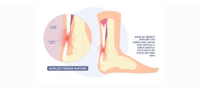 Get the Best Achilles tendonitis treatment in Singapore