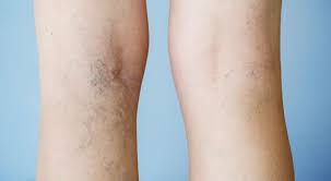 Myths and Misconceptions about Varicose Veins